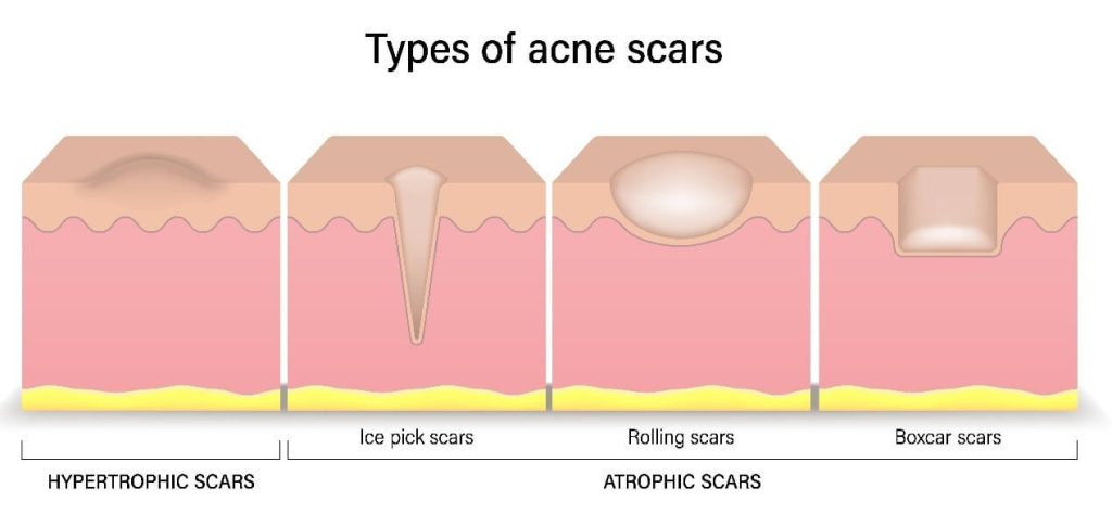 type of acne scars