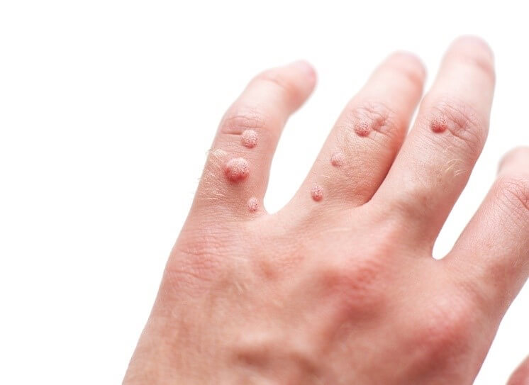 - יבלות ויראליות: נגעים פחות או יותר מורמים ולרוב מחוספסים, בעלי גוון עור או ורוד.