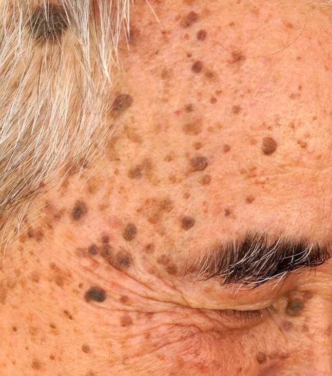 - יבלות שומניות ( SEBORRHEIC KERATOSIS): נגעי עור בולטים ע"פ העור, לרוב בגוון חום, ומחוספסים